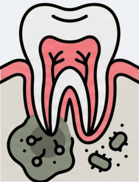 Periapical Disease