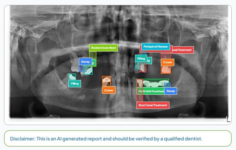 What OPGeniusAI detected on an OPG