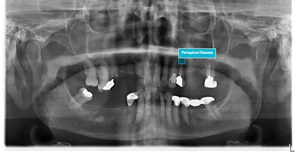 Periapical disease